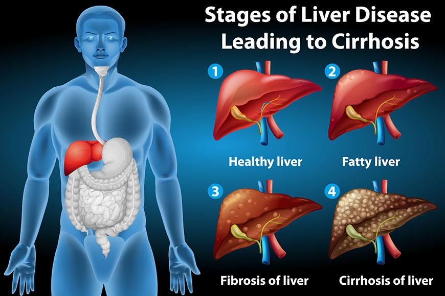 Liver disease Treatment